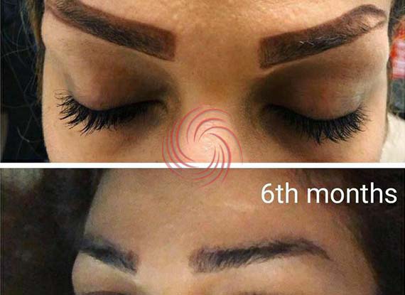 eyebrow transplant before and after 2