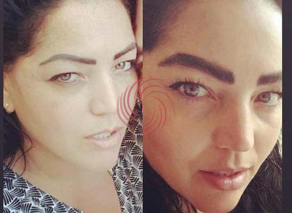 eyebrow transplant before and after 3