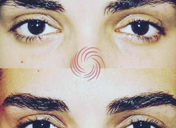 eyebrow transplant before and after 4