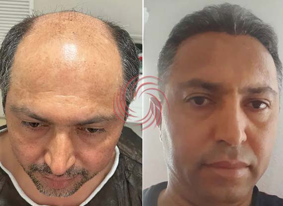 5700 Graft Hair Transplant Before and After