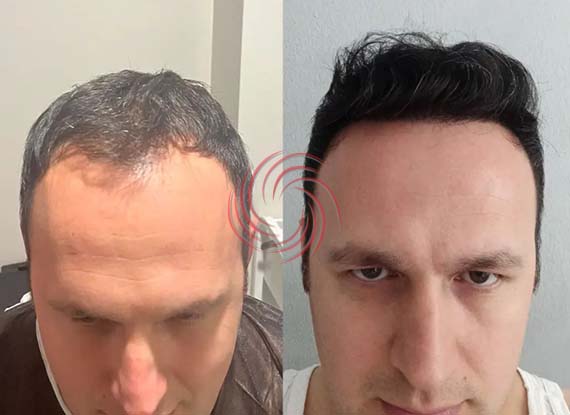 3600 Graft Hair Transplant Before and After