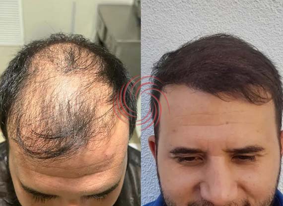 3600 Graft Hair Transplant Before and After