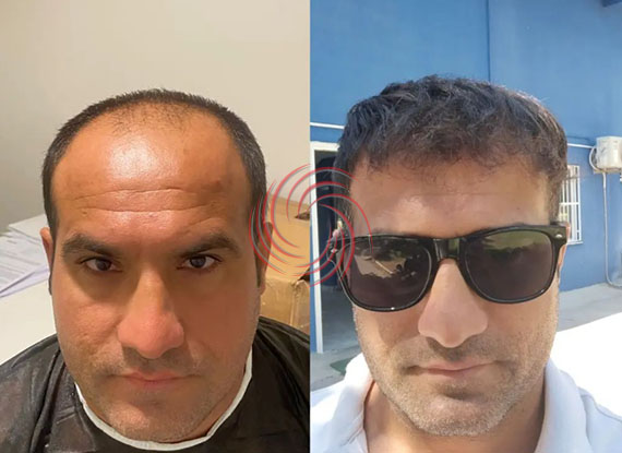 3000 Graft Hair Transplant Before and After