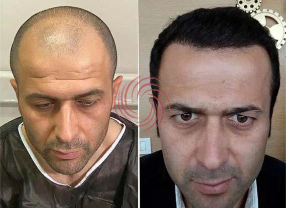 before and after hair transplantation 6