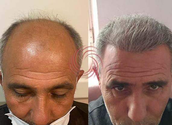 before and after hair transplantation 7