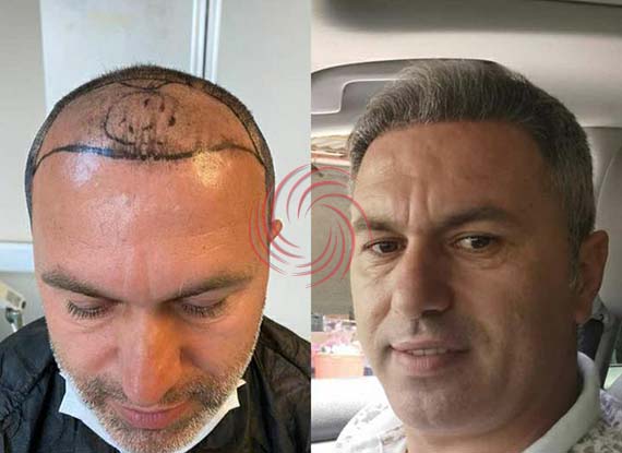 before and after hair transplantation 8