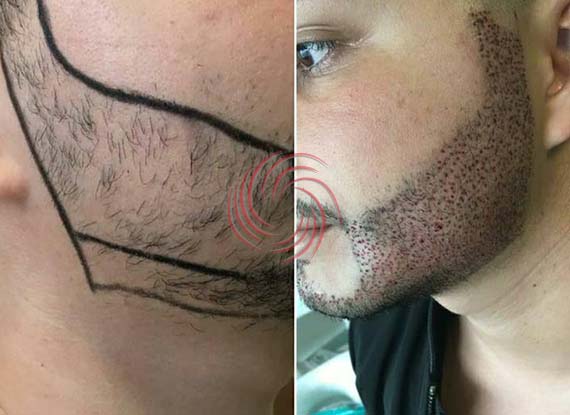 beard transplant before and after 1