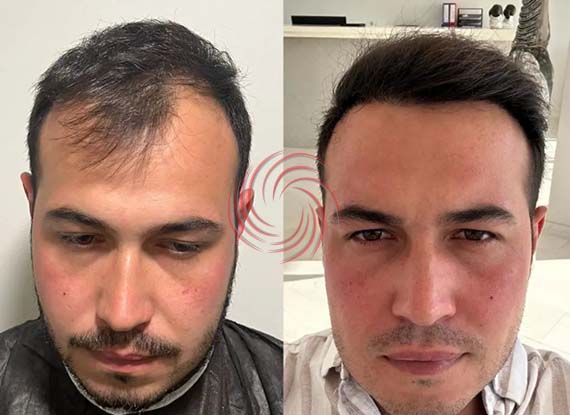 3000 Greft Saç Ekimi Öncesi Sonrası